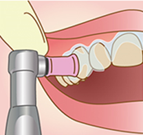 歯面をきれいにクリーニング