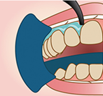 歯肉保護剤を塗布