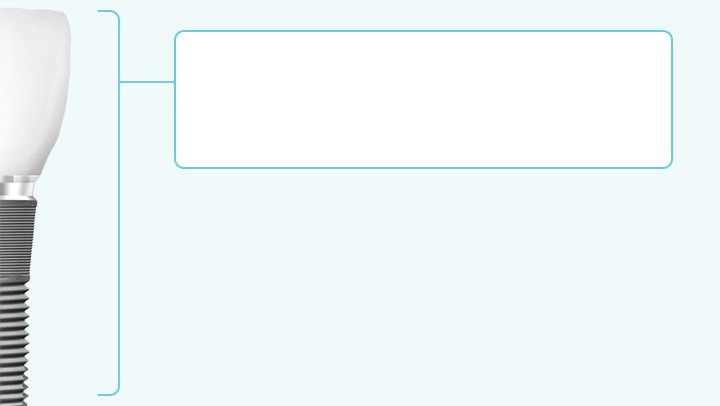 インプラント治療の費用