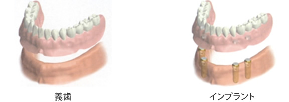 義歯とインプラントの治療イメージ