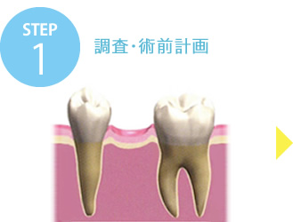 STEP1 調査・術前計画