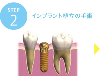 STEP2 インプラント植立の手術