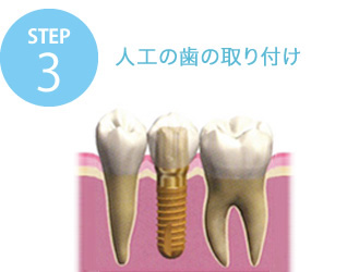STEP3 人口歯の取り付け