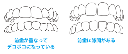 前歯が重なってデコボコになっている 前歯に隙間がある
