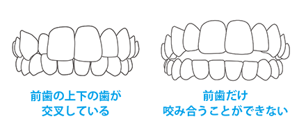 前歯の上下の歯が交叉している 前歯だけ咬み合うことができない
